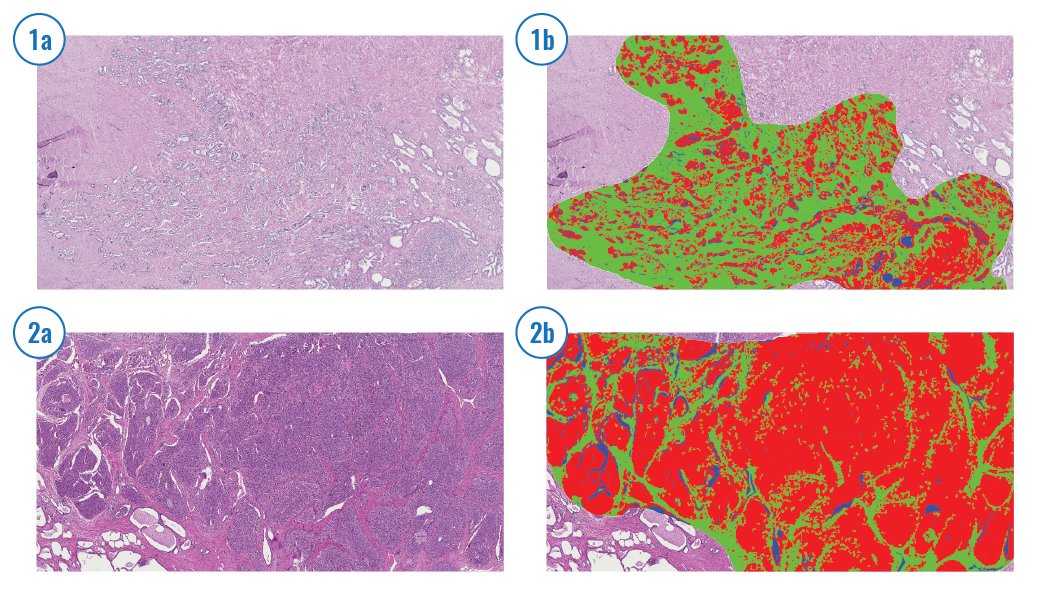 Stroma cells are automatically detected and shown in red. #DoMore!, @icgi.no