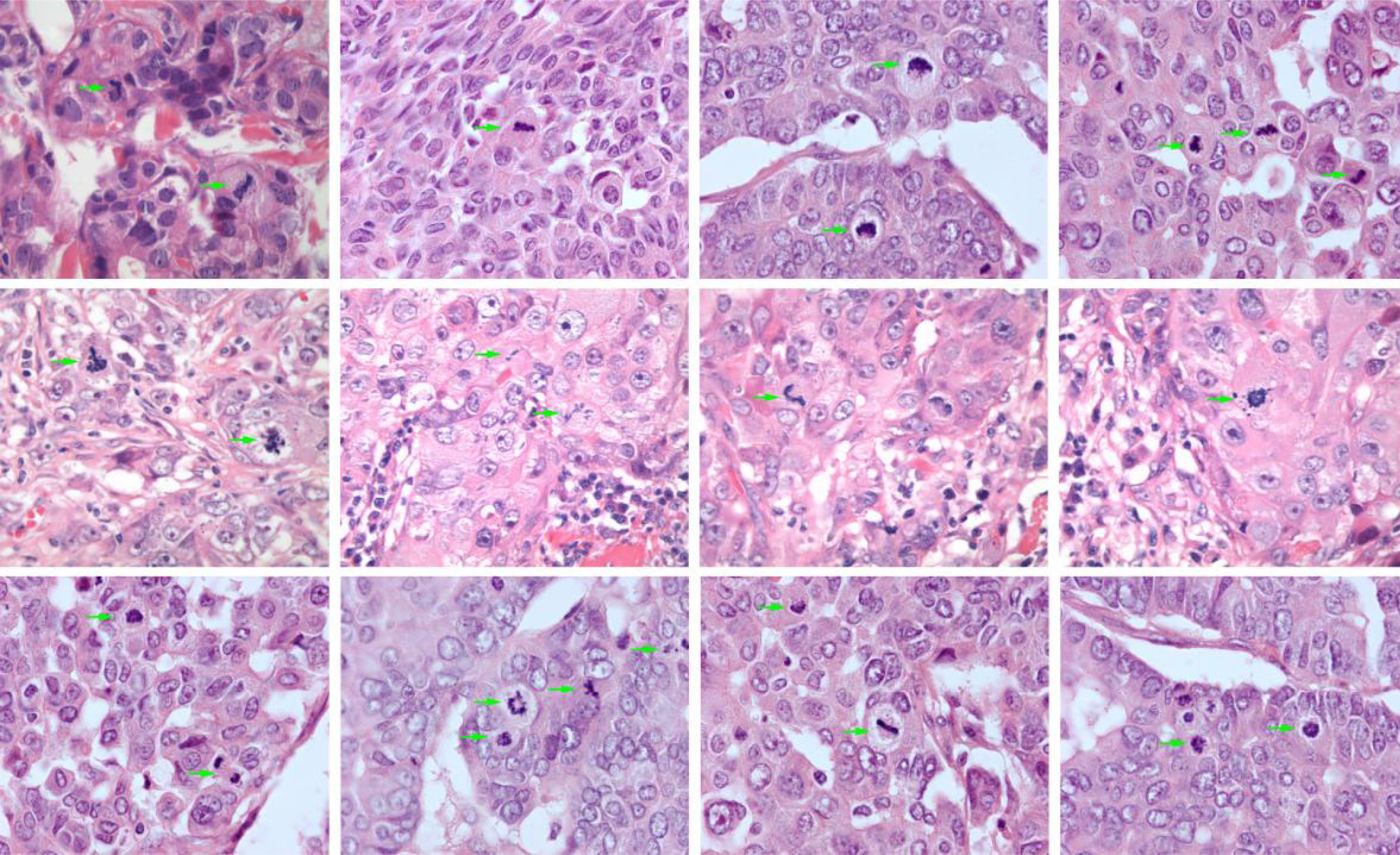 Examples of mitotic index annotation in breast cancer tissue samples. #DoMore!, @icgi.no